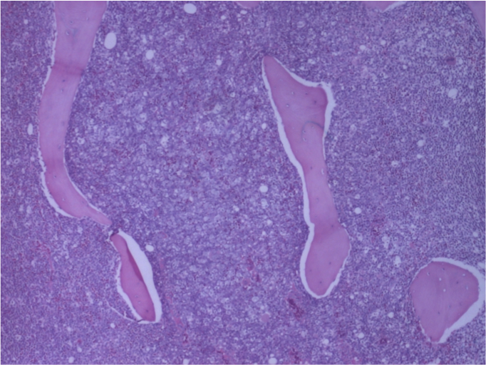BM biopsy